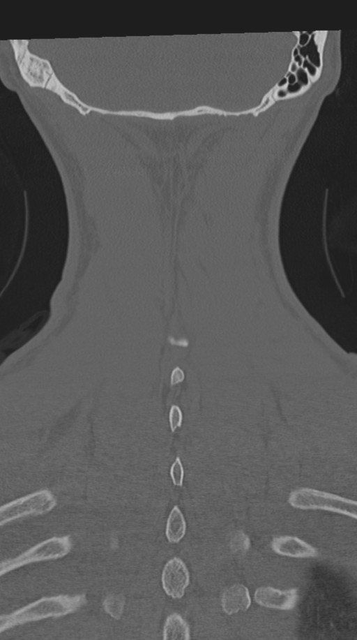 Cervical intercalary bone (Radiopaedia 35211-36748 Coronal bone window 66).png