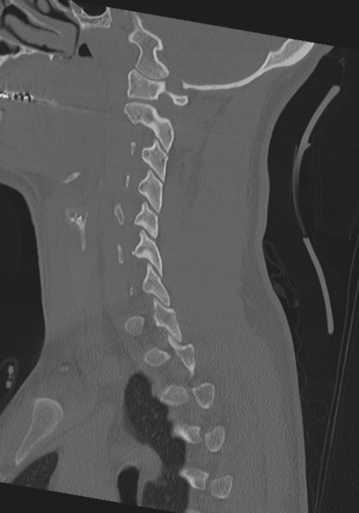 Cervical intercalary bone (Radiopaedia 35211-36748 Sagittal bone window 52).png