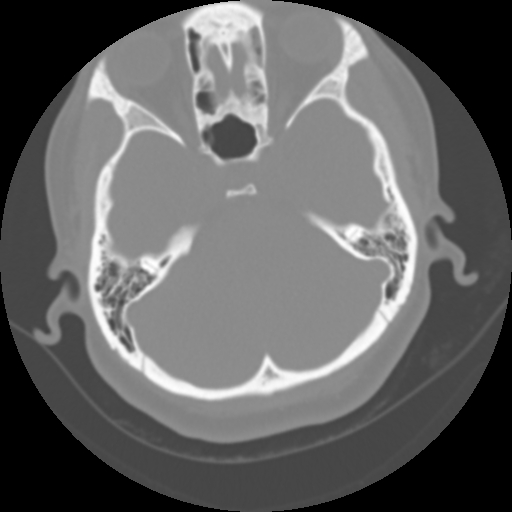 Cervical rib (Radiopaedia 71110-81363 Axial non-contrast 5).jpg