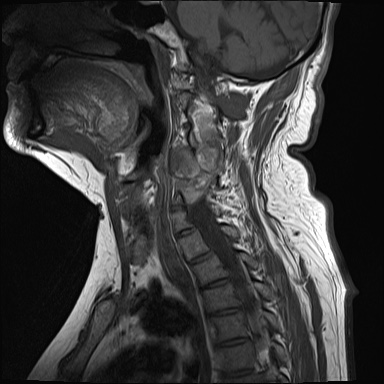 File:Cervical spinal neurofibroma in a patient with NF1 (Radiopaedia 58344-65465 Sagittal T1 8).jpg