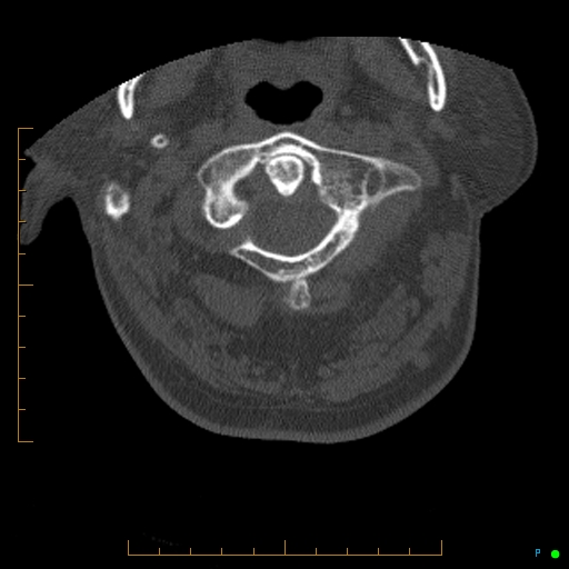 Cervical spine fracture - ankylosing spondylitis (Radiopaedia 76835-88706 Axial bone window 29).jpg