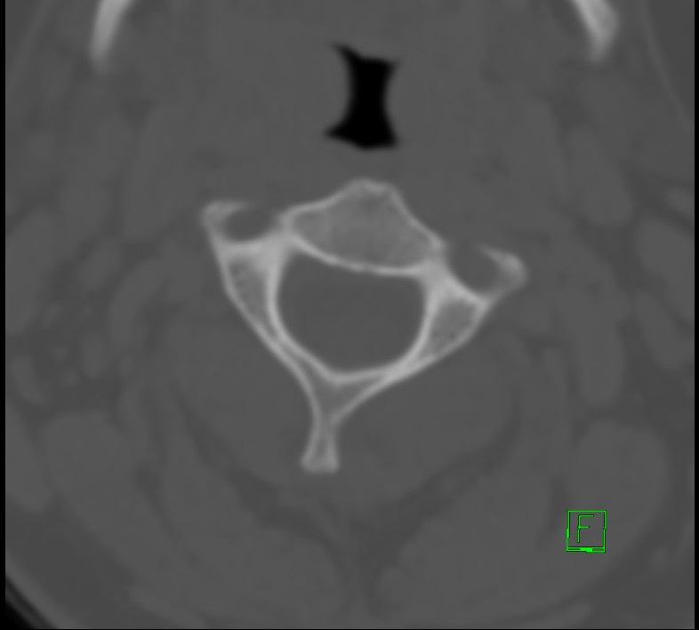 Cervical spine fracture - hyperflexion injury (Radiopaedia 66184-75364 Axial bone window 8).jpg