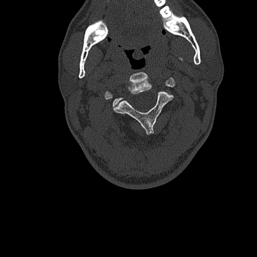 File:Cervical spine trauma with tear drop fracture and perched facet joint (Radiopaedia 53989-60127 Axial bone window 48).jpg