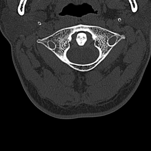 Cervical spondylodiscitis (Radiopaedia 28057-29489 Axial bone window 18).jpg