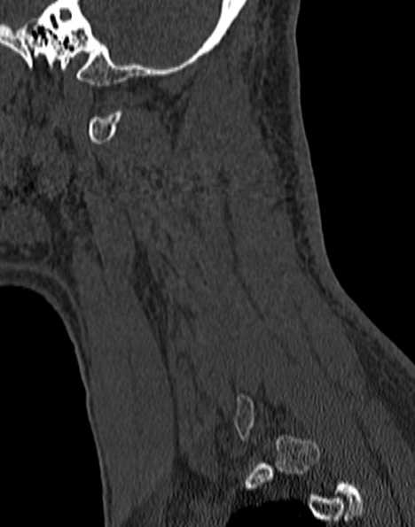 Cervical spondylodiscitis (Radiopaedia 28057-29489 Sagittal bone window 51).jpg