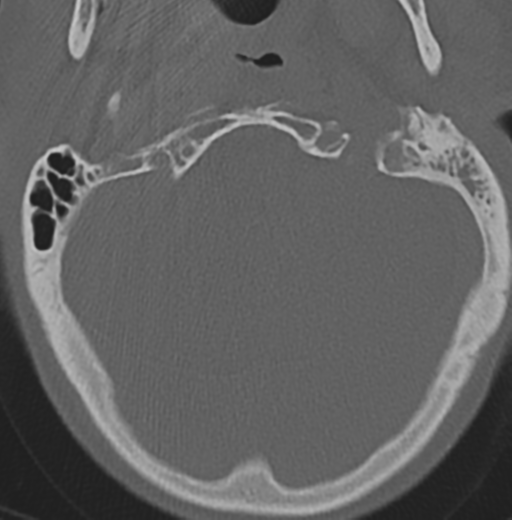 Cervical spondylolysis (Radiopaedia 49616-54811 Axial bone window 6).png