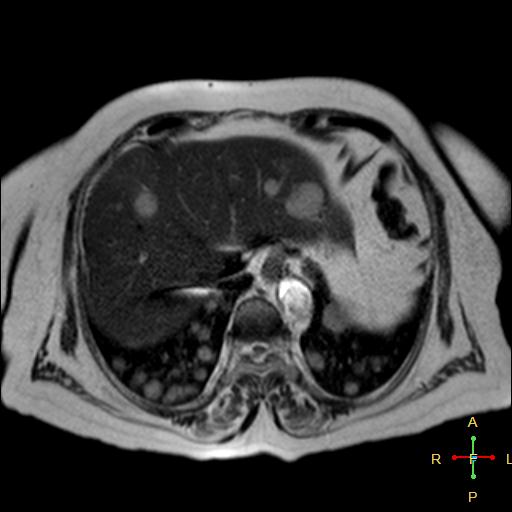 File:Cervical stump squamous cell carcinoma (Radiopaedia 48049-52858 I 16).jpg