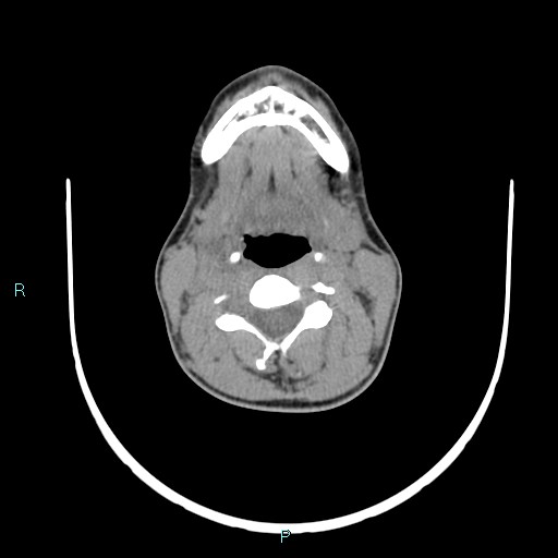 Cervical thymic cyst (Radiopaedia 88632-105335 Axial non-contrast 68).jpg