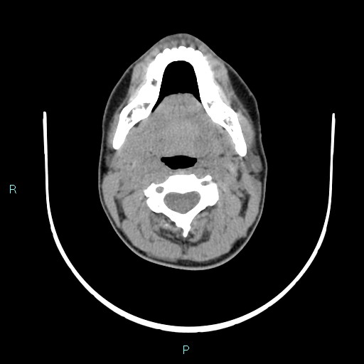 Cervical thymic cyst (Radiopaedia 88632-105335 Axial non-contrast 79).jpg