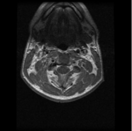 File:Cervical vertebrae metastasis (Radiopaedia 78814-91667 Axial T1 C+ 18).png
