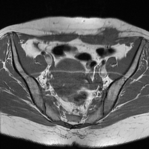 File:Cesarian section scar endometriosis (Radiopaedia 66520-75799 Axial T1 7).jpg