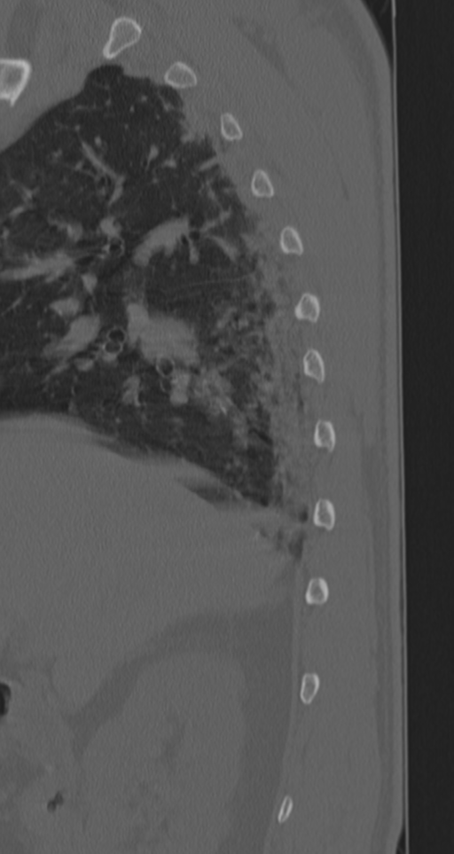 Chance fracture (Radiopaedia 33854-35020 Sagittal bone window 79).png
