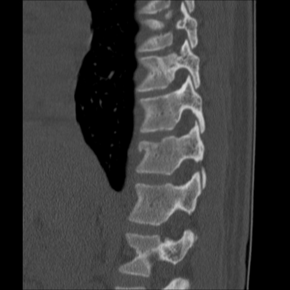 Chance fracture (Radiopaedia 36521-38081 Sagittal bone window 18).jpg