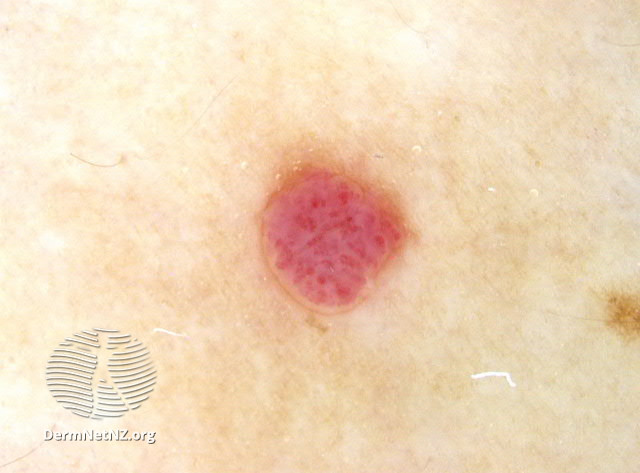 File:Cherry angioma 2 dermoscopic (DermNet NZ 128525).jpg