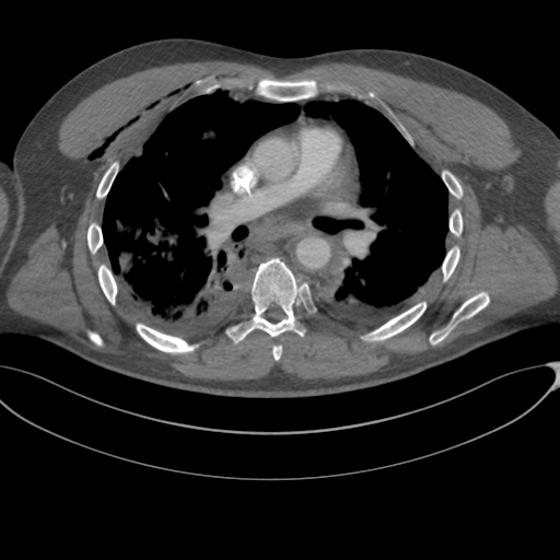 File:Chest multitrauma - aortic injury (Radiopaedia 34708-36147 A 139).png