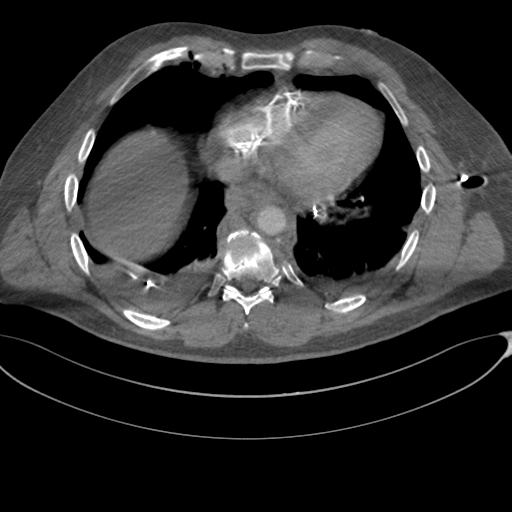 File:Chest multitrauma - aortic injury (Radiopaedia 34708-36147 A 208).png