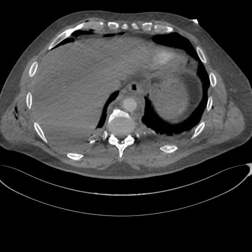 File:Chest multitrauma - aortic injury (Radiopaedia 34708-36147 A 243).png
