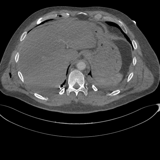 File:Chest multitrauma - aortic injury (Radiopaedia 34708-36147 A 259).png
