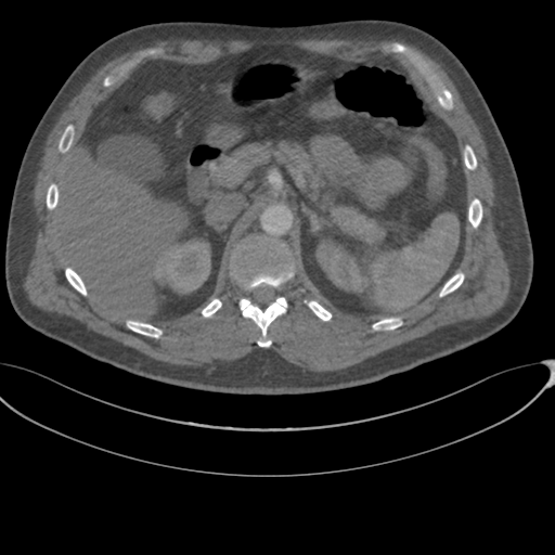 File:Chest multitrauma - aortic injury (Radiopaedia 34708-36147 A 308).png