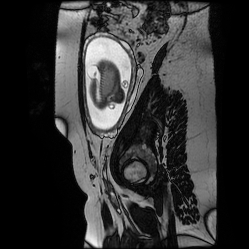 Chiari II malformation - fetal MRI (Radiopaedia 68099-77581 Sagittal Fiesta 11).jpg