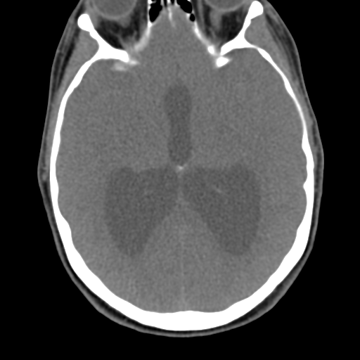 Chiari I malformation and obstructive hydrocephalus (Radiopaedia 41185-43981 D 13).png