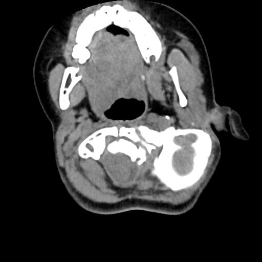 Chiari I with syrinx and skull base anomalies (Radiopaedia 89444-106412 Axial non-contrast 50).jpg