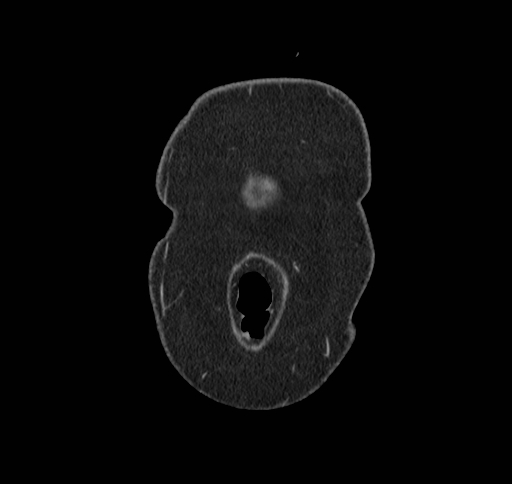 File:Cholecystoduodenal fistula (Radiopaedia 48959-54022 B 2).jpg