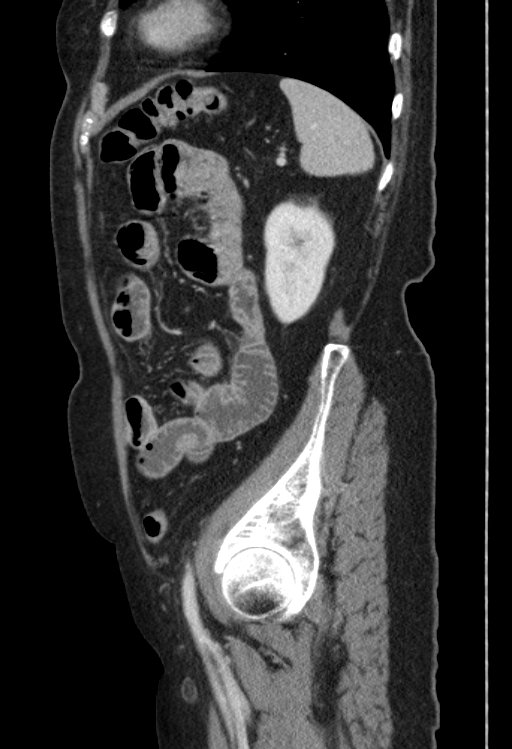 Cholecystoduodenal fistula due to calculous cholecystitis with gallstone migration (Radiopaedia 86875-103077 F 13).jpg