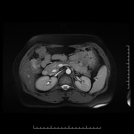 File:Choledochal cyst with chronic calcific pancreatitis (Radiopaedia 18245-18062 Axial T2 9).png