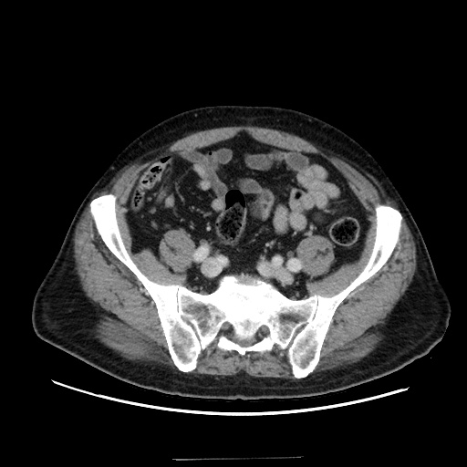 Choledocholiathiasis with normal caliber common bile duct (Radiopaedia 75368-86632 A 143).jpg