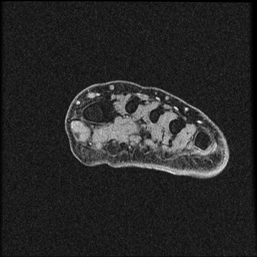 File:Chondroblastoma - midfoot (Radiopaedia 64831-73765 F 28).jpg