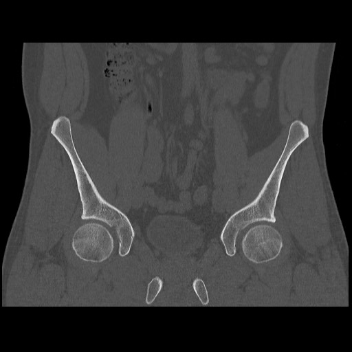 Chondrosarcoma of iliac wing (Radiopaedia 63861-72599 Coronal bone window 48).jpg