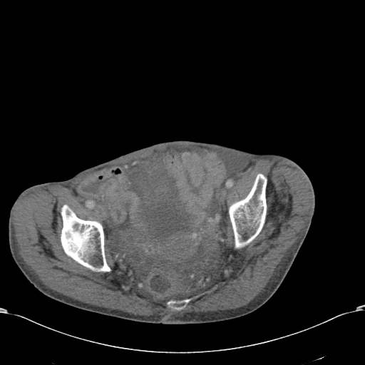 Chondrosarcoma of the spine (Radiopaedia 49871-55143 A 56).jpg