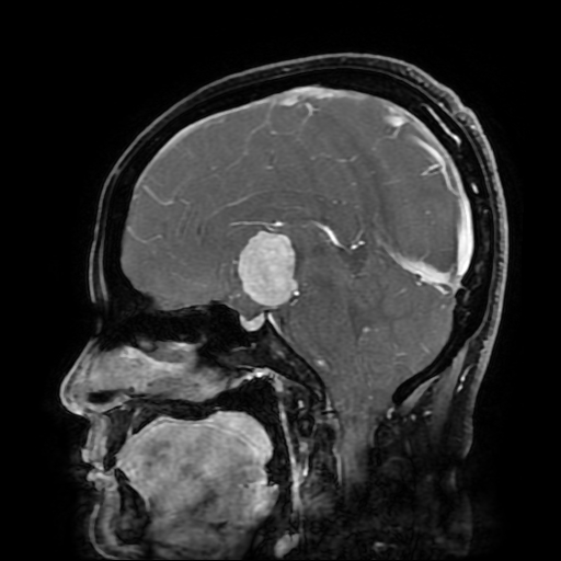 File:Chordoid glioma of third ventricle (Radiopaedia 91612-109340 F 104).jpg