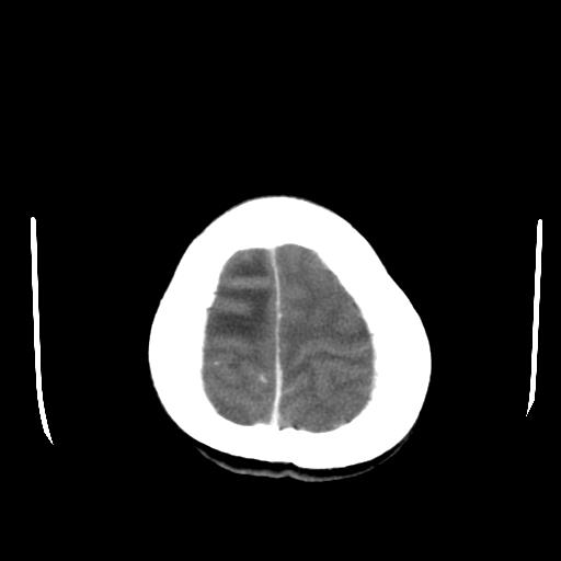 File:Choriocarcinoma of ovary with cerebral and pulmonary metastases (Radiopaedia 25983-26118 A 24).jpg