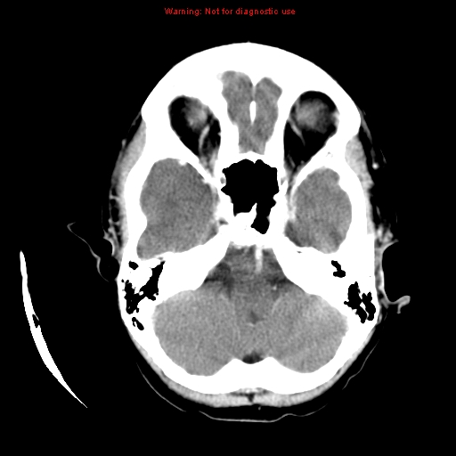 File:Choroid plexus carcinoma - recurrent (Radiopaedia 8330-9168 B 5).jpg