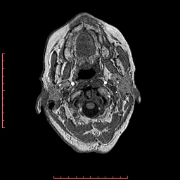 Choroid plexus xanthogranuloma (Radiopaedia 67843-77270 Axial T1 156).jpg