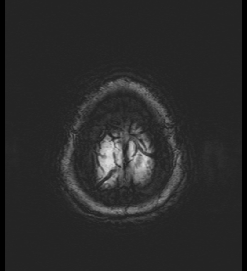 Choroid plexus xanthogranuloma (Radiopaedia 91271-108875 Axial SWI 58).jpg