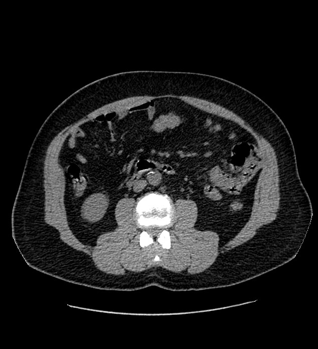 Chromophobe renal cell carcinoma (Radiopaedia 84337-99693 Axial non-contrast 72).jpg