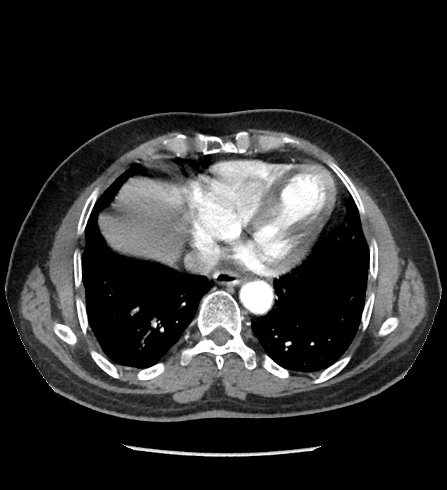 Chromophobe renal cell carcinoma (Radiopaedia 86879-103083 B 8).jpg