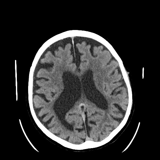 Chronic bilateral subdural hygroma (Radiopaedia 85801-101622 Axial non-contrast 48).jpg