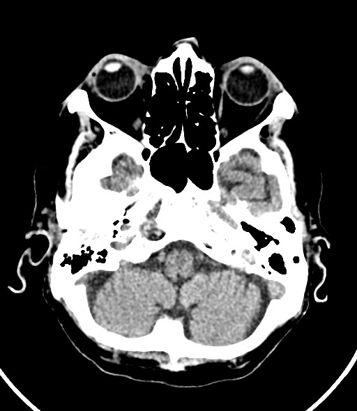File:Chronic bilateral subdural hygroma (Radiopaedia 85801-101623 Axial non-contrast 49).jpg
