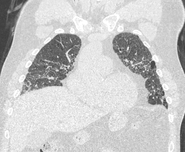 File:Chronic hypersensitivity pneumonitis (Radiopaedia 48107-52922 Coronal lung window 10).png