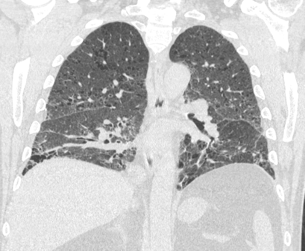 File:Chronic hypersensitivity pneumonitis (Radiopaedia 48107-52922 Coronal lung window 17).png