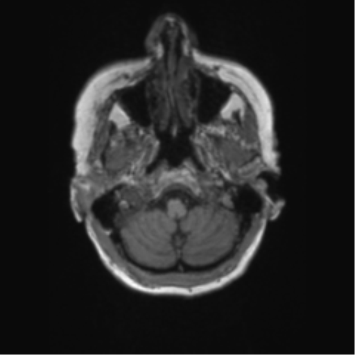 Chronic hypertensive encephalopathy (Radiopaedia 72844-83495 Axial T1 63).png