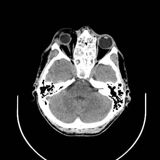 Chronic invasive fungal sinusitis (Radiopaedia 50342-55710 Axial non-contrast 47).jpg