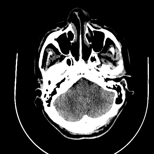 Chronic invasive fungal sinusitis (Radiopaedia 91563-109286 Axial non-contrast 13).jpg