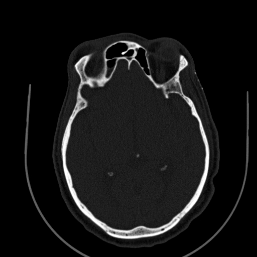 Chronic invasive fungal sinusitis (Radiopaedia 91563-109286 Axial sinus 118).jpg