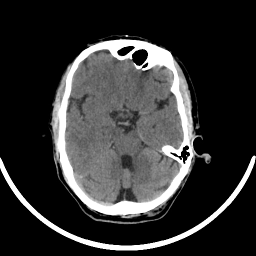 File:Chronic invasive fungal sinusitis with intraorbital and intracranial extension (Radiopaedia 56387-63046 Axial non-contrast 162).jpg