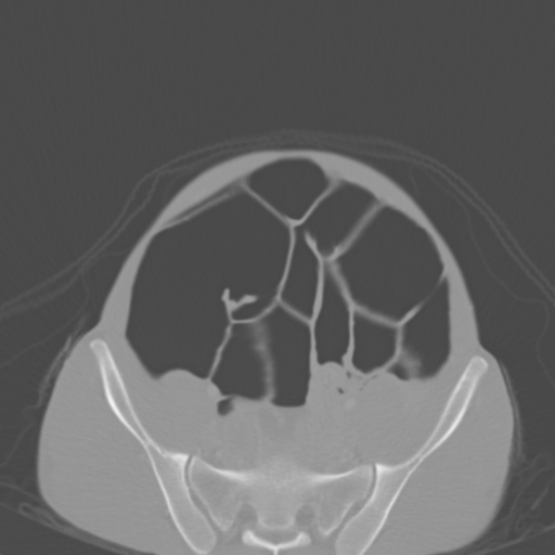 Chronic large bowel pseudo-obstruction (Radiopaedia 43181-46492 Axial bone window 133).jpg